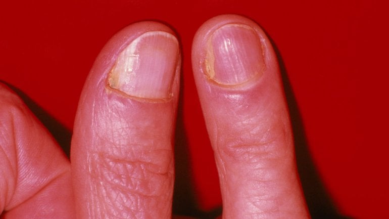 Brüchige, gelblich verfärbte Nägel: Bild von Hautpilz am Nagel