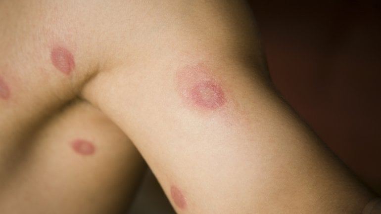 Hautpilz: Bilder von kreisrundem Ausschlag