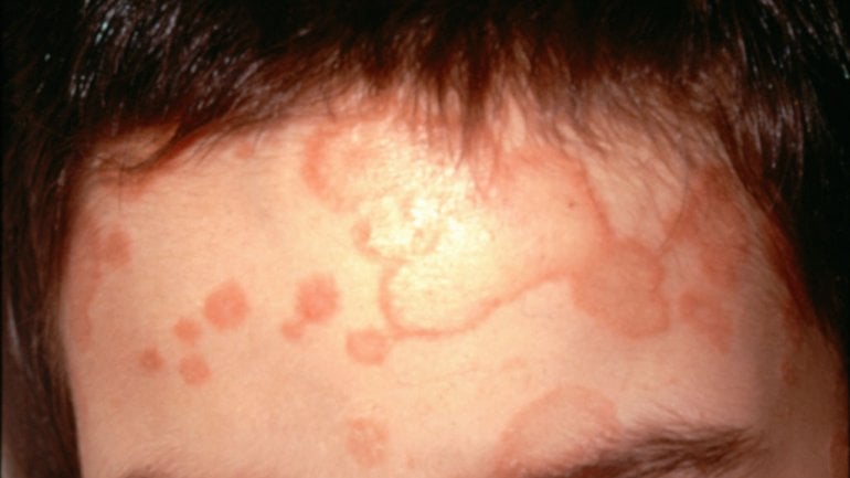 Foto von Hautpilz im Gesicht