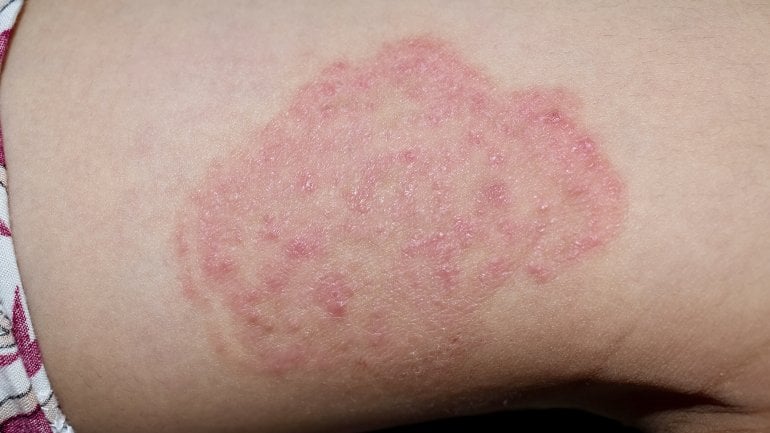 Bilder von Hautpilz: Kann eine Pilzinfektion stressbedingt sein?