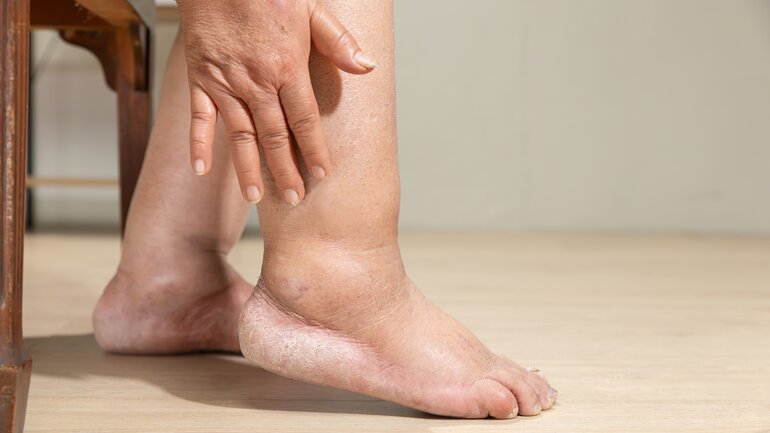 Symptom bei Herzkrebs: Wassereinlagerungen