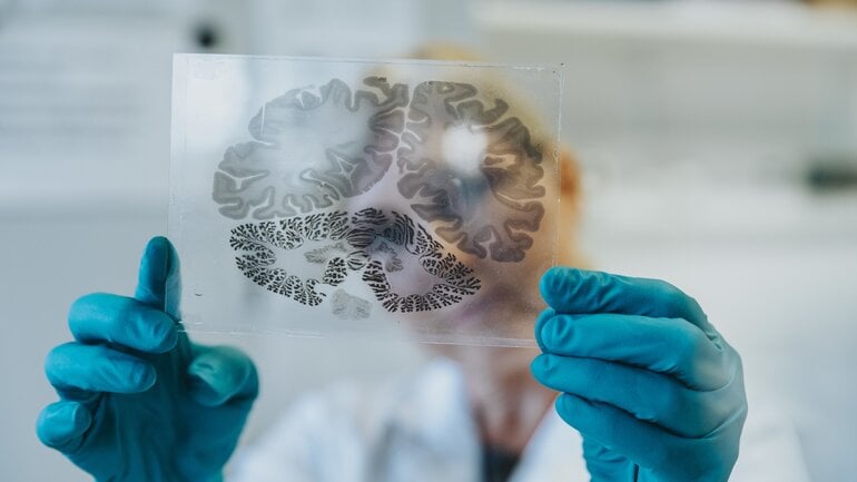 Hirnkrebs: Ependymom ist seltener Tumor im Kopf