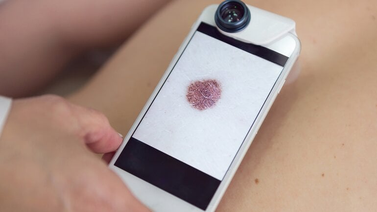 Hautkrebs mithilfe von künstlicher Intelligenz schon früh erkennen