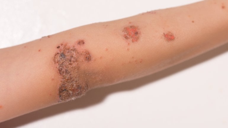 Hautkrankheit bei Kindern: Impetigo contagiosa
