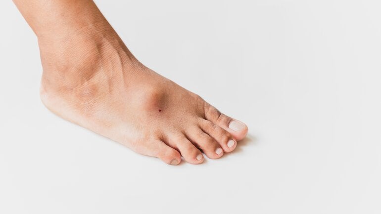 Knubbel am Fuß: Überbein oder Ganglion