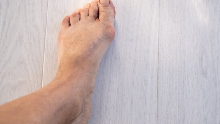 Knubbel am Fuß: Hallux valgus als Ursache
