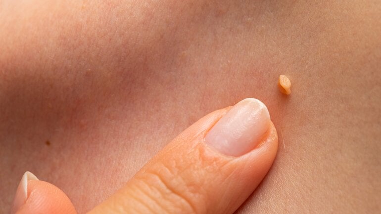 Papillom: Gutartiger Knubbel am Hals