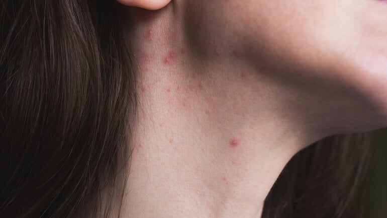 Knoten am Hals: Pickel kann dahinterstecken