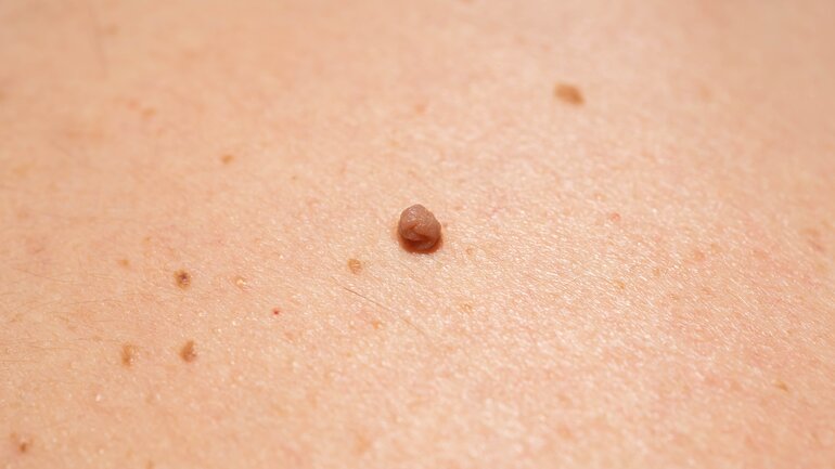 Knubbel: Stielwarze am Hals