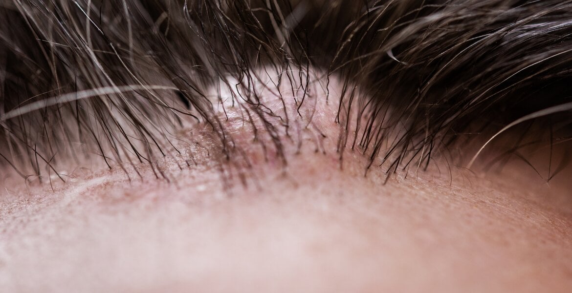 Knubbel am Kopf: Atherom am Kopf eines Mannes