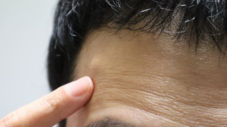 Knubbel am Kopf durch Lipom