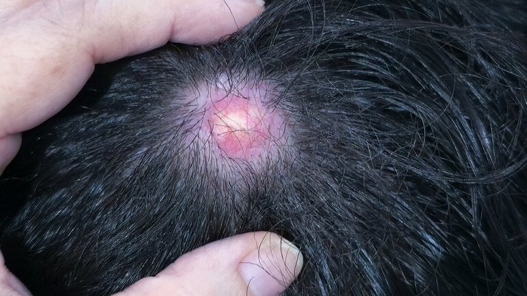 Knubbel am Kopf: Ist es ein Furunkel?