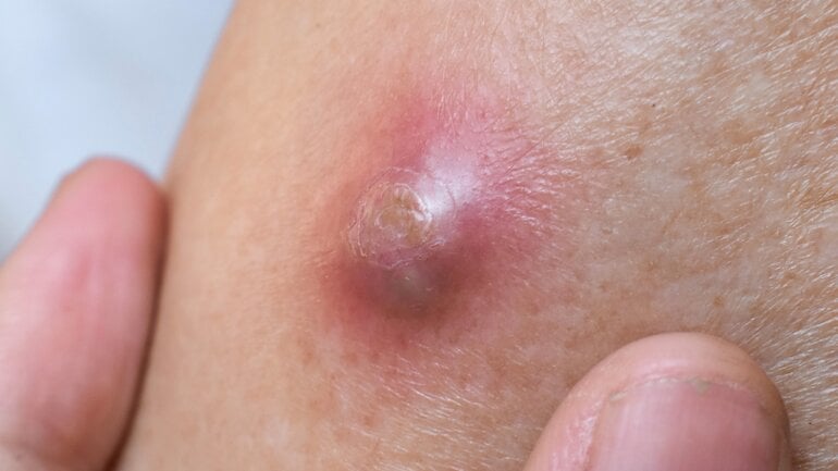 Knubbel am Kopf tut weh: Abszess