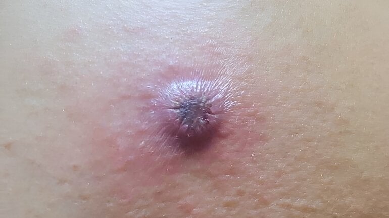 Katzenkratzkrankheit: Bilder und Symptome der Infektion