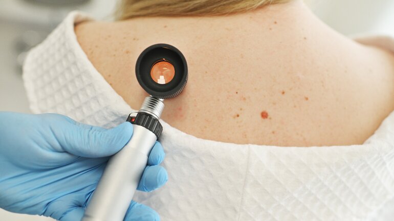 Hautkrebs gehört zu den häufigsten Krebsarten