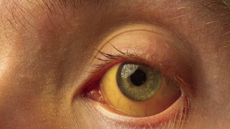 Symptom bei Leberentzündung: Gelbsucht