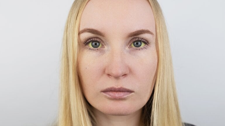 Gelbsucht: Symptom bei fortgeschrittener Leberfibrose