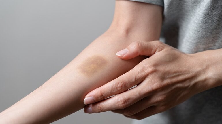 Blutgerinnungsstörung bei fortgeschrittener Leberfibrose