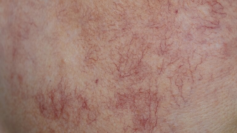 Spider naevi sind typische Leberhautzeichen