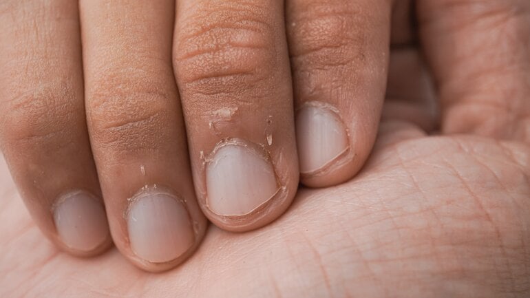 Weiße Nägel können Anzeichen für kranke Leber sein