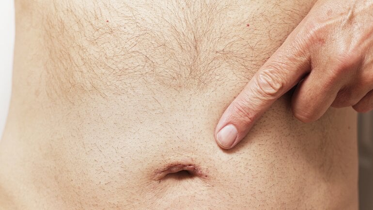 Leberhautzeichen: Bauchglatze als Hinweis auf Lebererkrankung