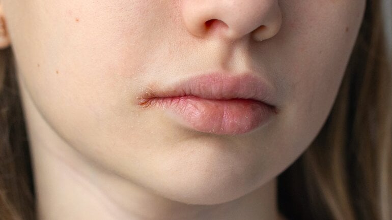 Kranke Leber? Eingerissene Mundwinkel können Anzeichen sein