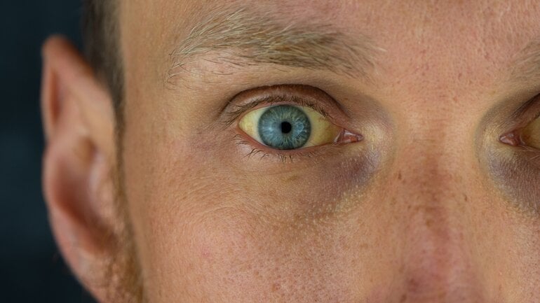Leberinfarkt: Gelbsucht ist Symptom