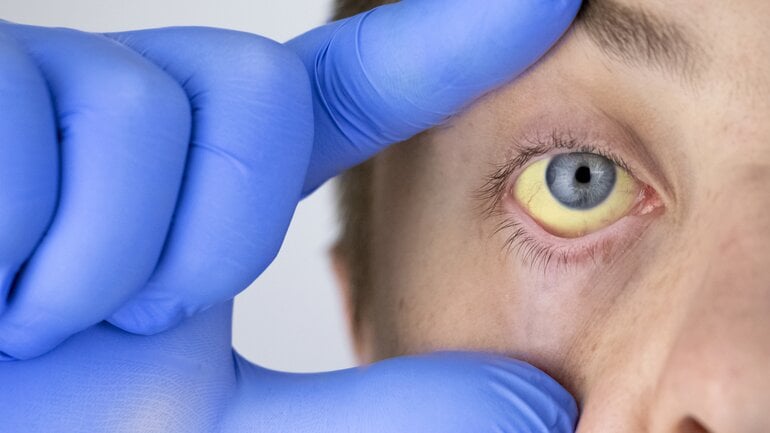 Leberversagen: Gelbsucht ist Warnzeichen