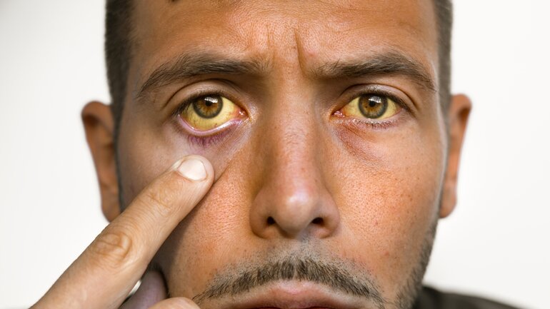 Gelbfärbung der Haut? Symptom bei schlechten Leberwerten