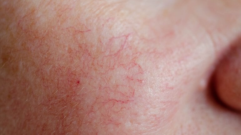 Leberzirrhose: Erweiterte Gefäße und Rötung im Gesicht