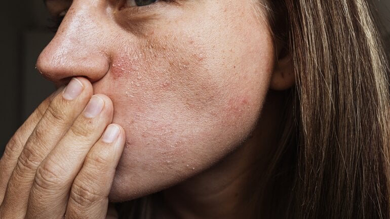 Leberzirrhose: Trockene Haut im Gesicht