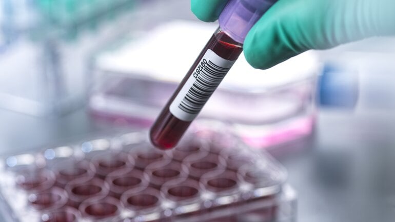 Akute myeloische Leukämie ist weitere Art