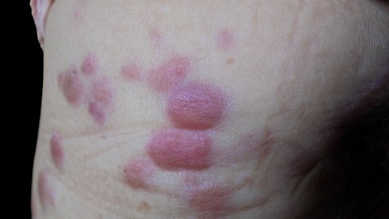 Leukämie: Infiltration der Haut 