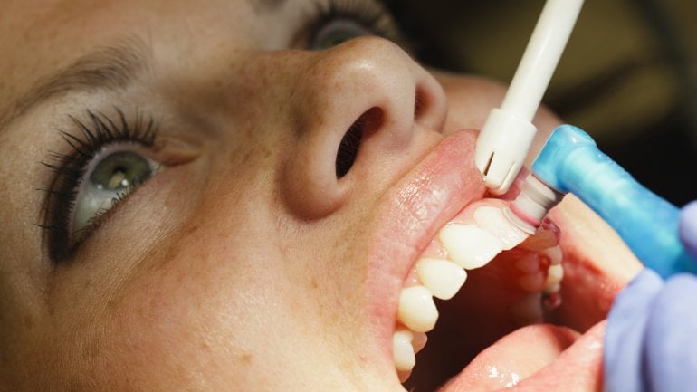 Professionelle Zahnreinigung hilft gegen Mundgeruch