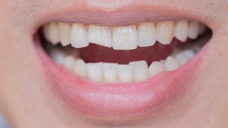 Zahnverletzungen? Ärztliche Kontrolle wichtig