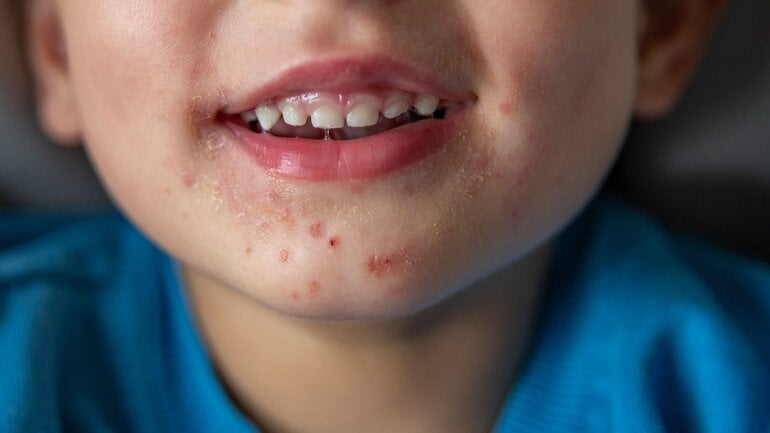 Hand-Fuß-Mund-Krankheit betrifft meist Kinder