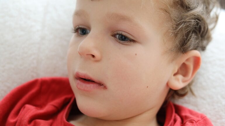 Mundfäule: Was ist herpetische Stomatitis?