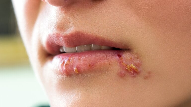 Herpes am oder im Mund