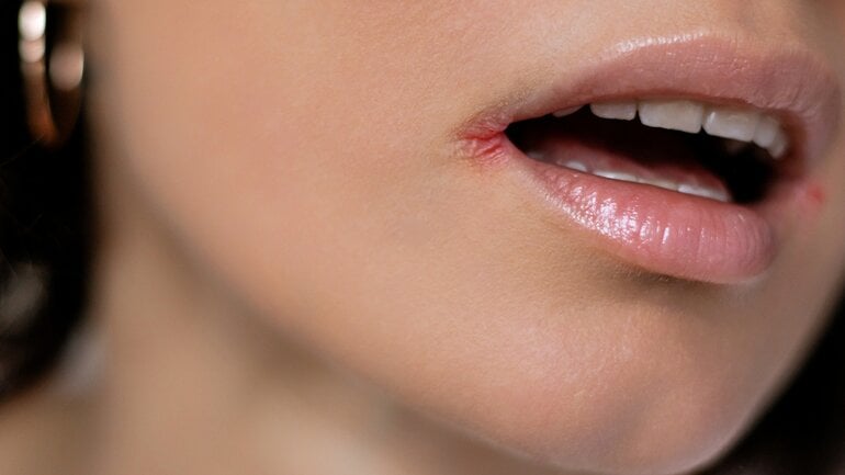 Eingerissene Mundwinkel