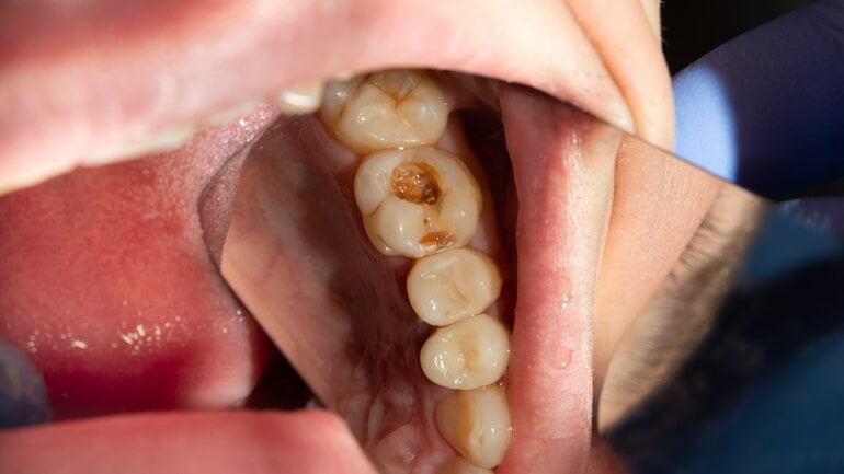 Karies ist häufige Mundkrankheit