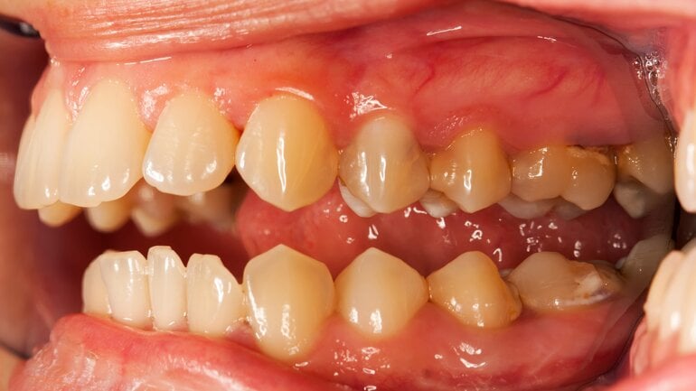 Häufige Munderkrankung: Parodontitis