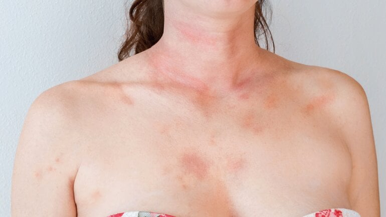 Hautveränderungen: Symptom bei Dermatomyositis