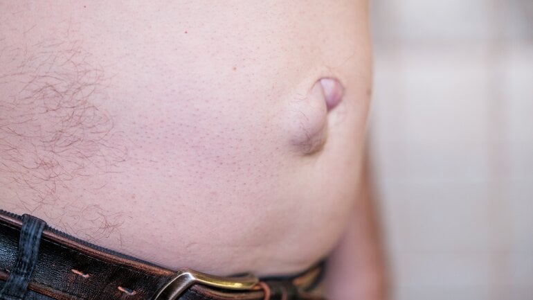 Symptome bei Nabelhernie: Dicker Bauch durch Nabelbruch