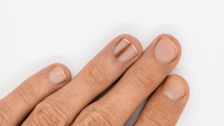 Bilder von Nagelkrebs: Schwarzer Strich im Nagel