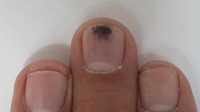 Nagelkrebs: Schwarzer Fleck im Nagel