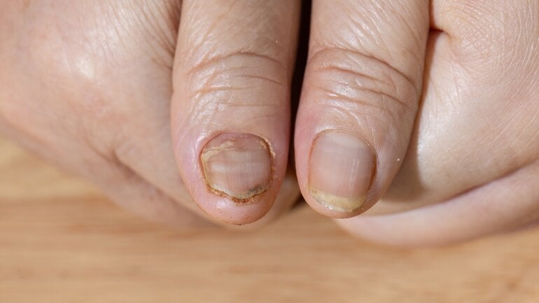 Nagelkrebs: Verformter Nagel kann Symptom sein
