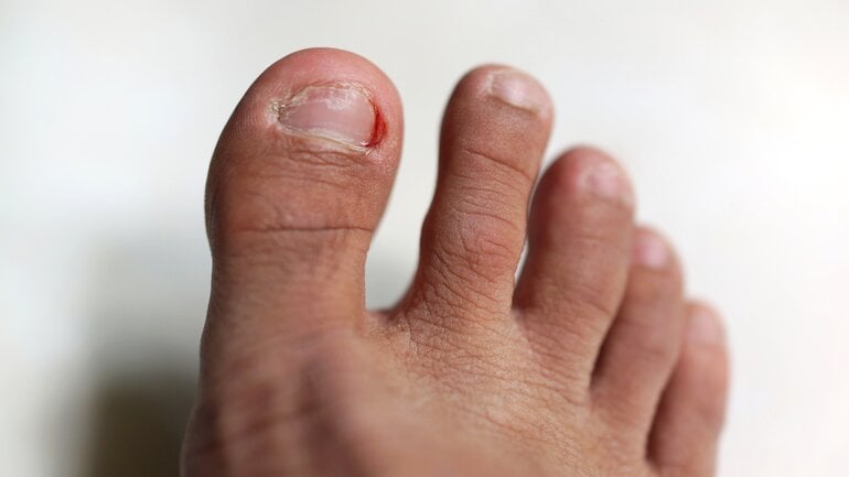 Bilder von Nagelkrebs: Wunden und Blutungen