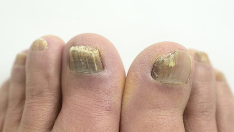 Braun verfärbte Nägel: Ist es Nagelkrebs?