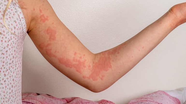 Hautreaktion ist mögliches Symptom bei Nussallergie