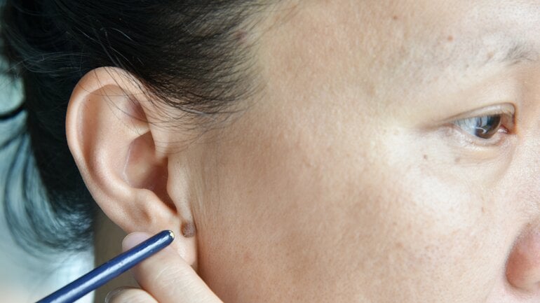 Hautkrebs am Ohr? Mögliche Symptome